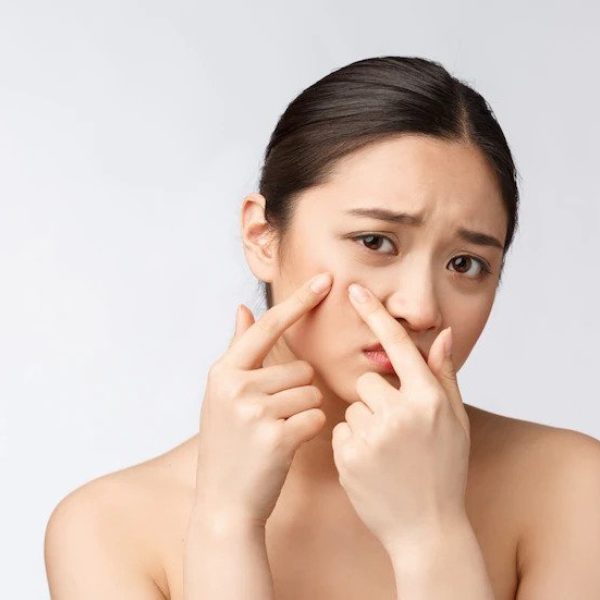 【暗瘡解碼】暗瘡位置反映健康問題?即睇暗瘡護理及去印方法!