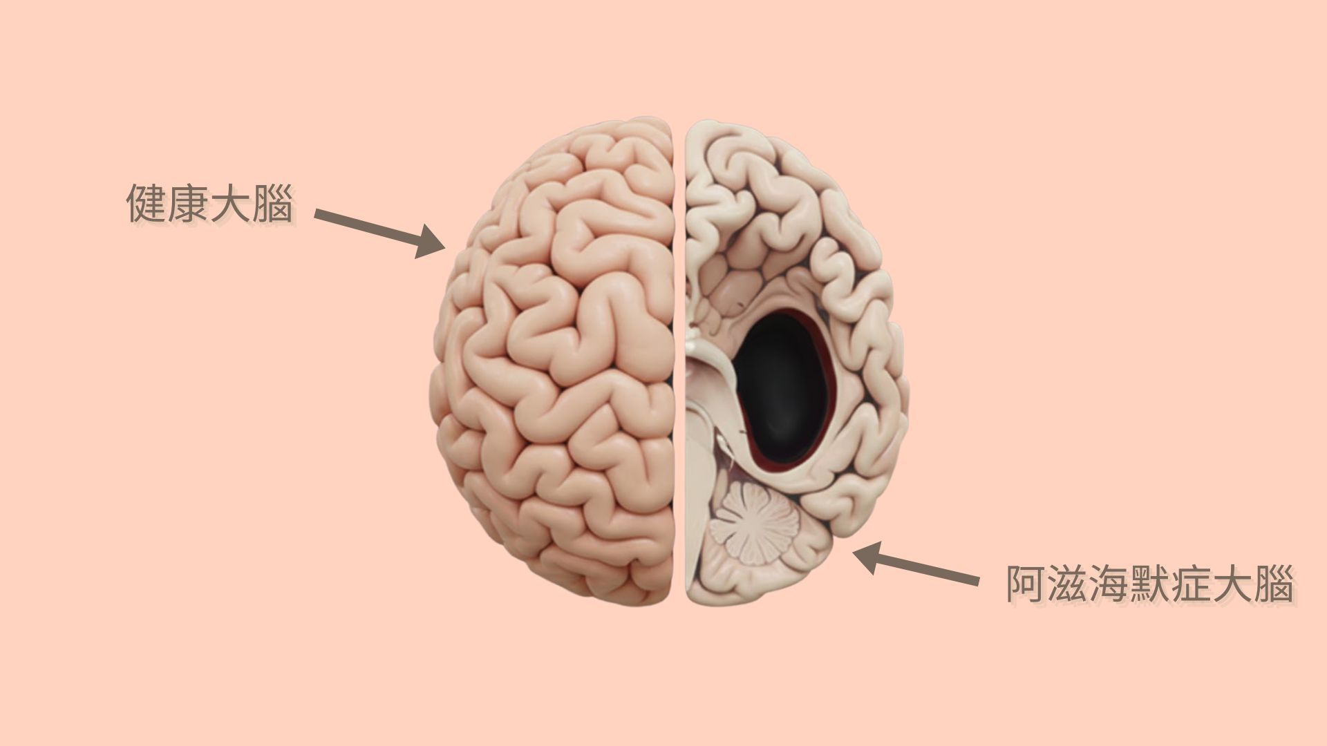 阿茲海默症大腦