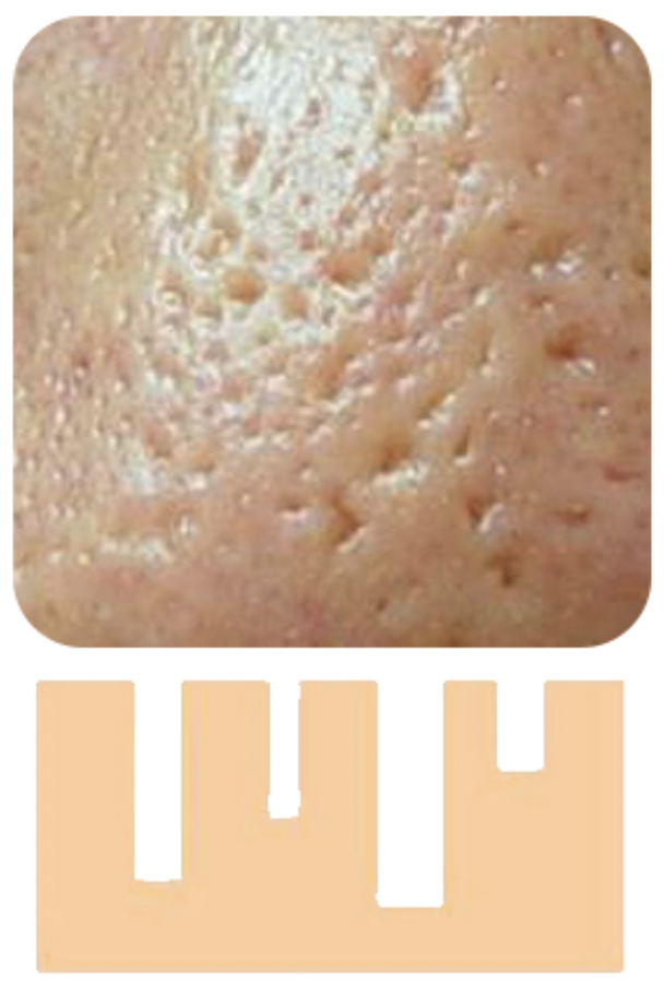 冰鑿型 (Ice Pick Scars)