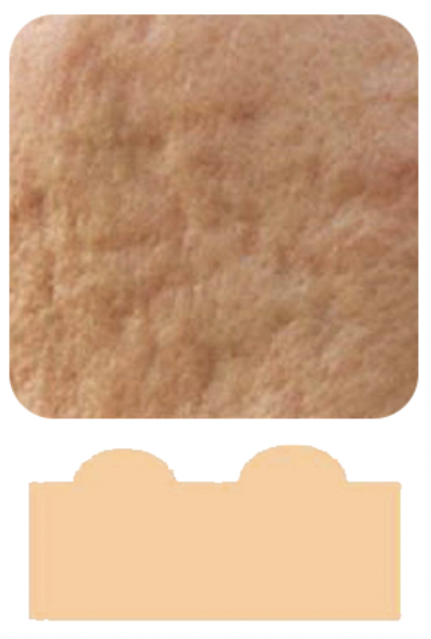 滾動型（Rolling Scars)