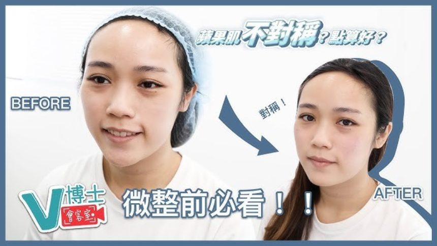 【V博士會客室】微整前必看！！蘋果肌不對稱？可以怎麼辦？