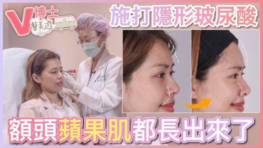 【V博士醫美遊】施打隱形玻尿酸！ 額頭蘋果肌都長出來了！網美實錄分享ft. iSKIN 尚行美健康聯合診所