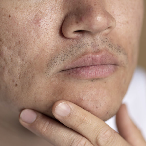 【暗瘡凹凸洞】必讀！CUREjet肌關鎗解決凹凸洞，無痛不反彈！