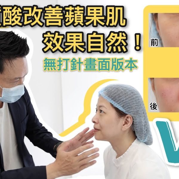 【V博士會客室】 (無打針版本）隱形質酸改善蘋果肌？效果自然！同樣面部問題的女生可以參考一下！