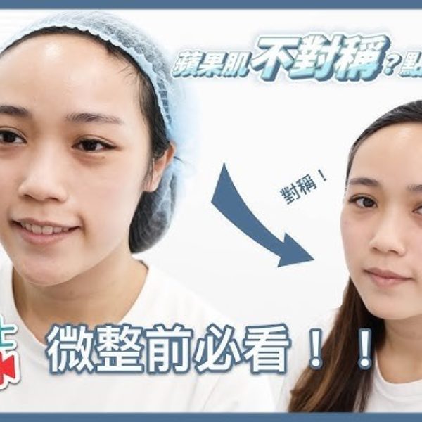 【V博士會客室】微整前必看！！蘋果肌不對稱？可以怎麼辦？
