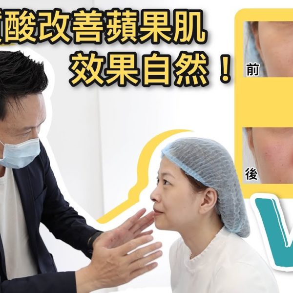 【V博士會客室】 隱形質酸改善蘋果肌？效果自然！同樣面部問題的女生可以參考一下！